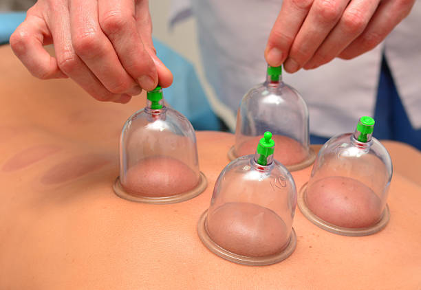 Vacuum cupping Therapy