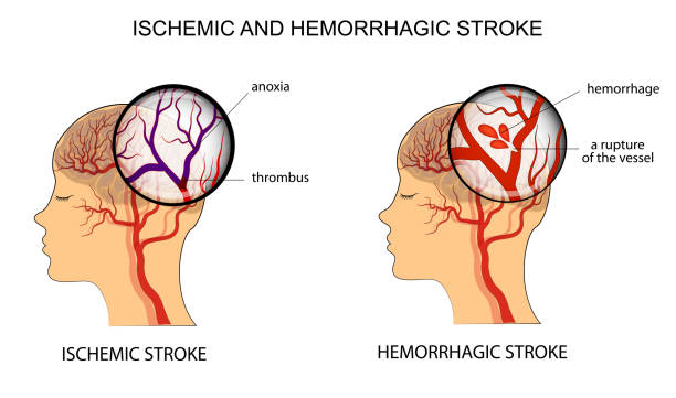 Physiotherapist for stroke